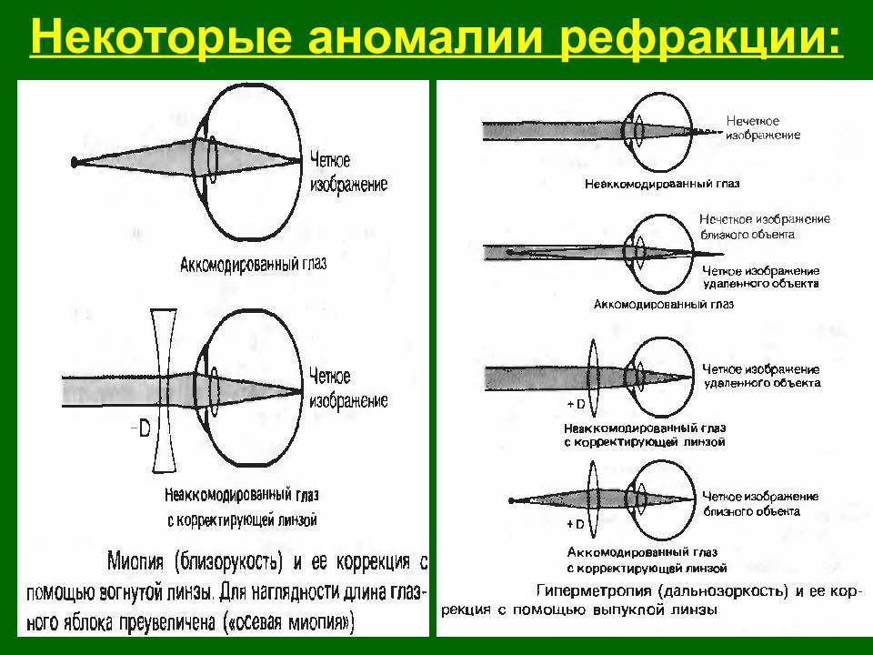 Коррекция аномалий рефракции. Интраокулярная коррекция аномалий рефракции. Рефракция нарушение рефракции. Способы коррекции аномалий рефракции. Понятие рефракции, ее аномалии.