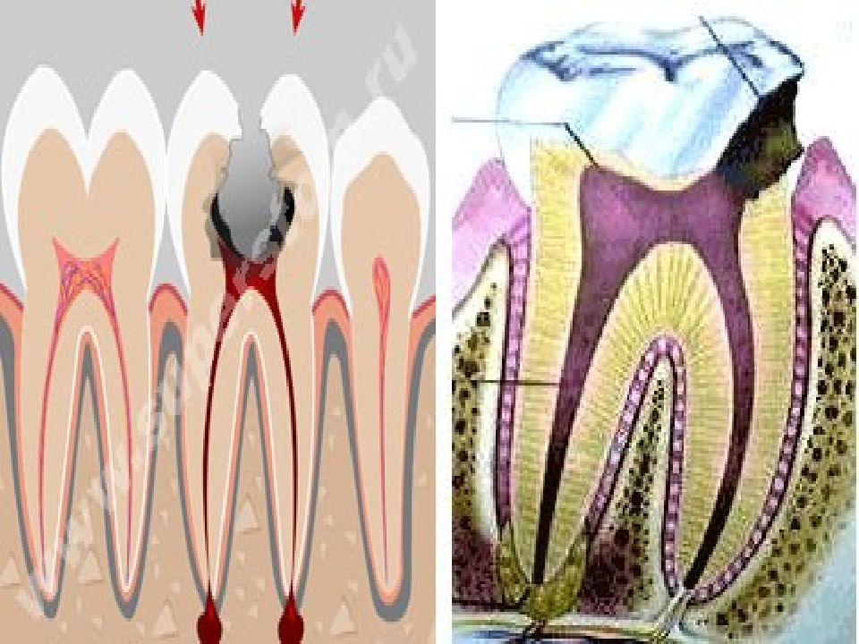 Периодонтит это. Пролиферационный пульпит. Строение зуба кариес пульпит.