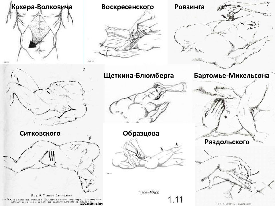 Клиническая картина острого аппендицита