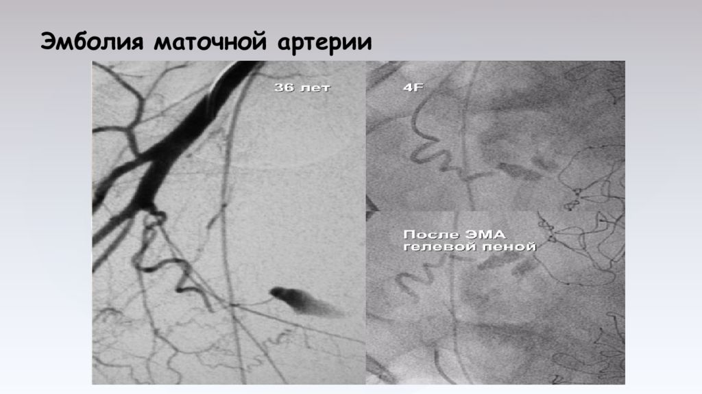 Маточная артерия. Эмболия амниотической жидкостью. Отхождения маточной артерии:.