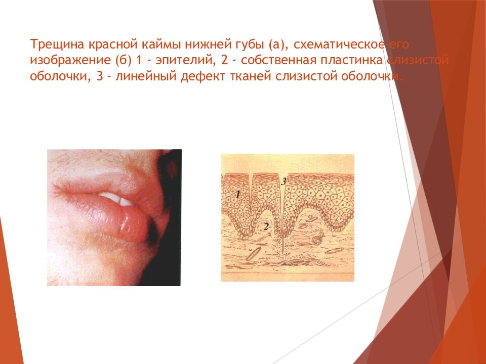 Трещина красной каймы нижней губы (а), схематическое его изображение (б) 1 - эпителий, 2 - собственная пластинка слизистой оболочки, 3 - линейный дефект тканей
