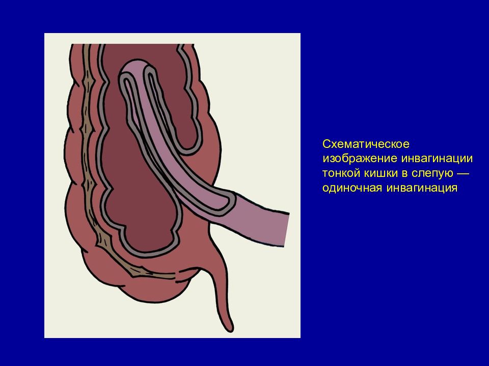 Инвагинация кишечника. Тонко-тонкокишечная инвагинация кишечника. Инвагинация слепой кишки кт. Инвагинация кишечной тракт. Тонко-толстокишечная инвагинация.