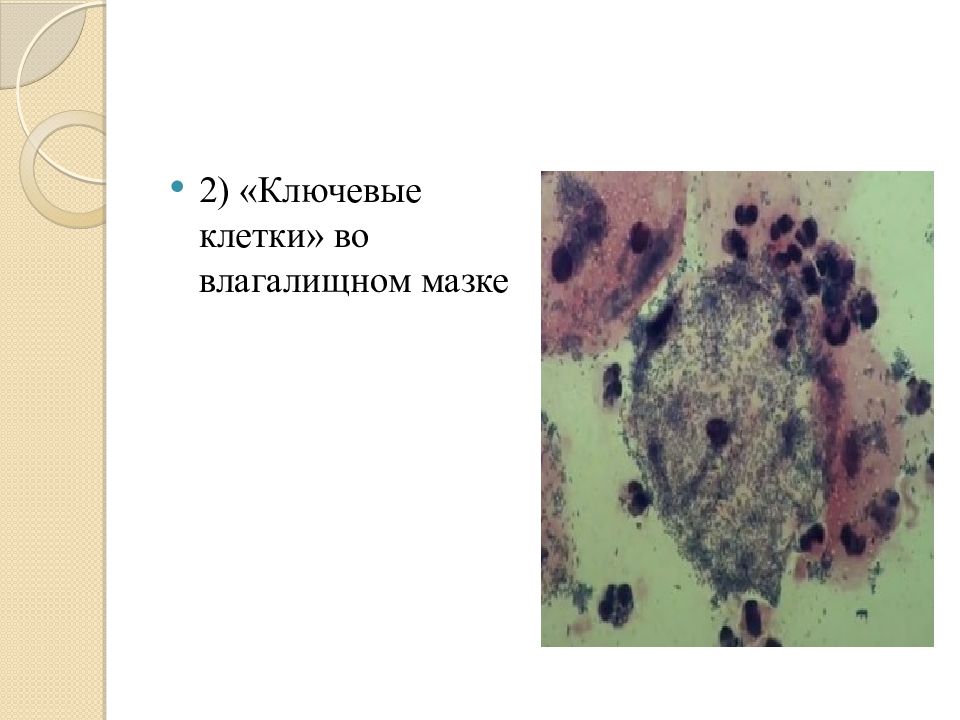 Дисбиоз во влагащение что это. Ключевые клетки в мазке под микроскопом. Бактериальный вагиноз микроскопия. Ключевые клетки при бактериальном вагинозе. Ключевая клетка в гинекологическом мазке.