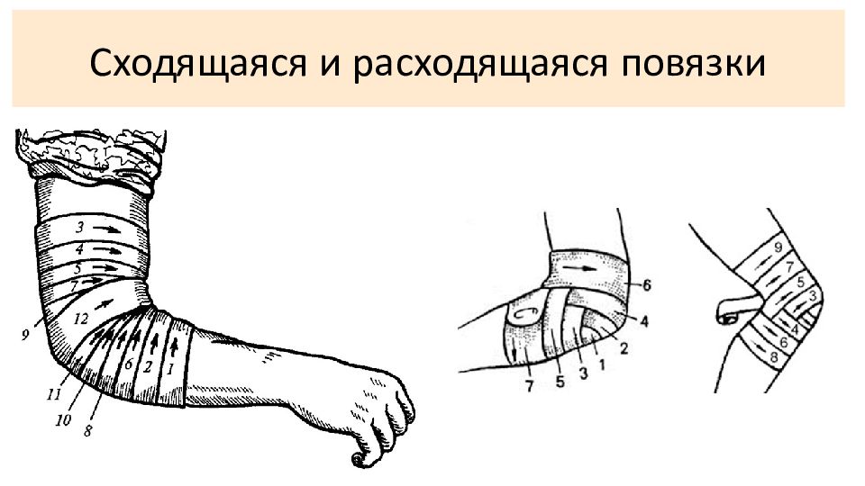 черепашья повязка на коленный сустав. сходящаяся черепашья повязка на локтевой сустав. черепашья сходящаяся повязка на коленный сустав алгоритм. черепашья схожящиеся на коленныц сустав. расходящаяся повязка.