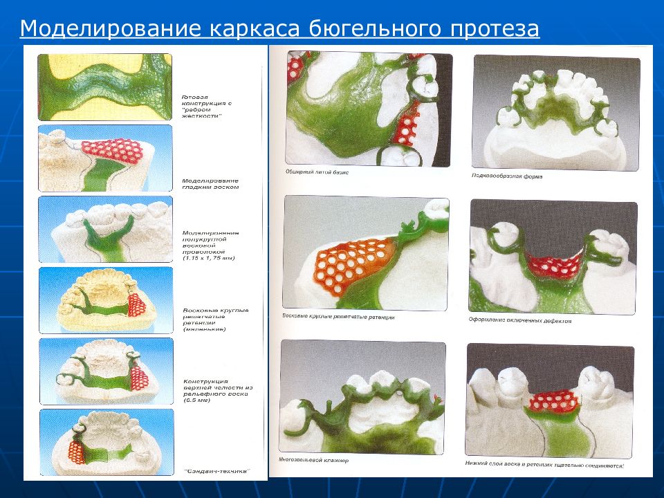 Нанесение рисунка каркаса бюгельного протеза на модель