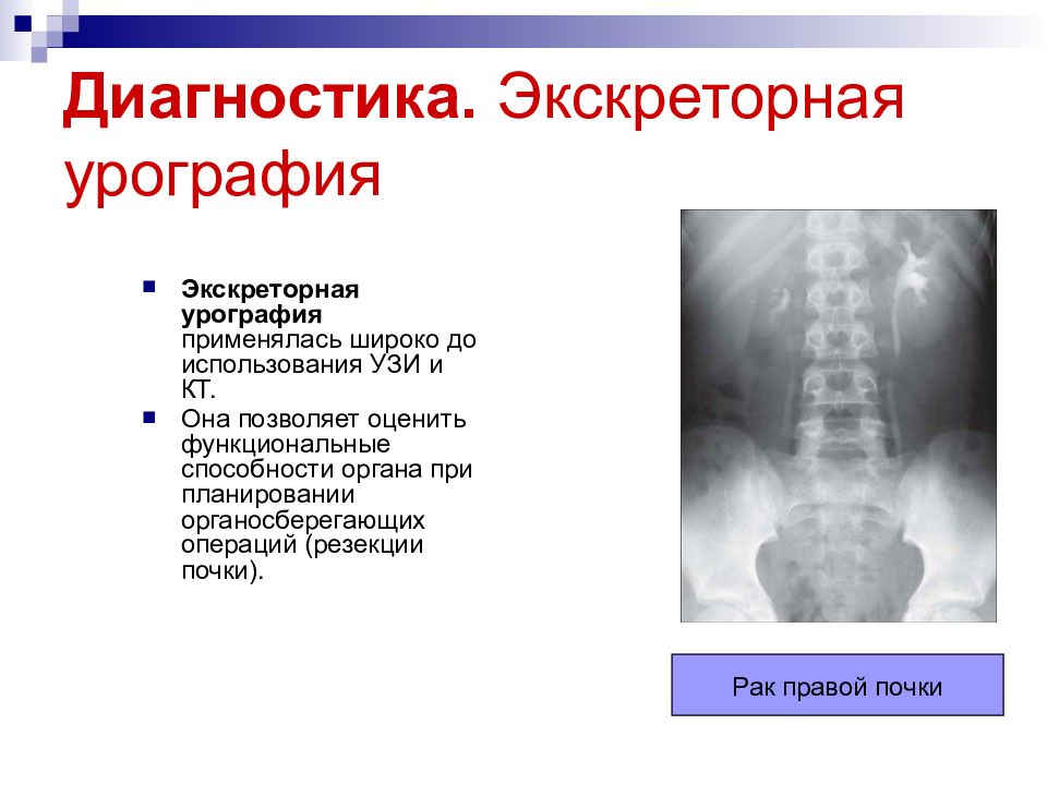 Экскреторная урография картинки