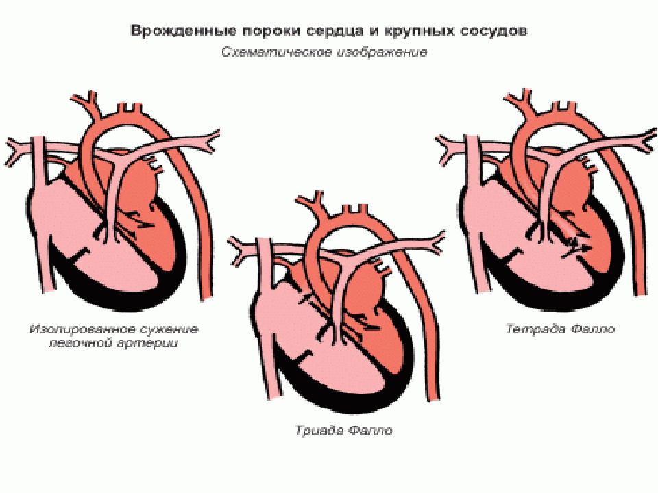 Блок схема пороки сердца