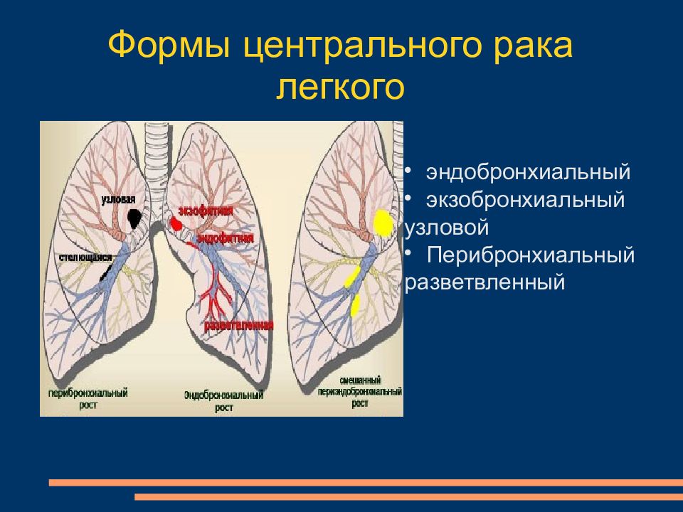 Центральное легкое. Центральная опухоль легкого. Центральное заболевание легкого. Центральный CR правого легкого.