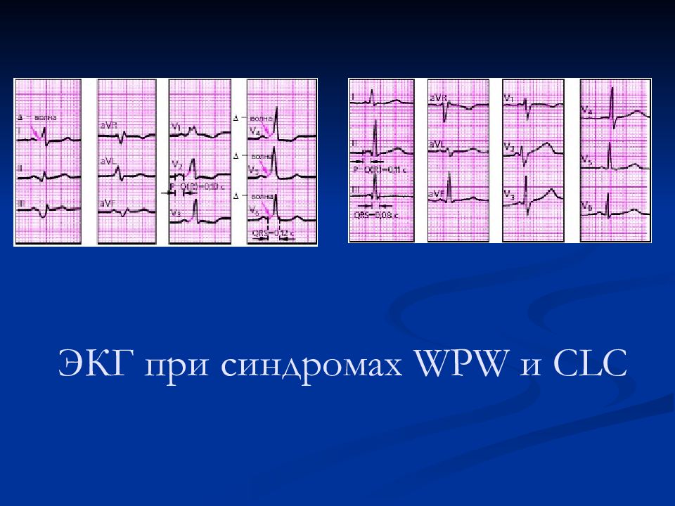 Кардиограмма синдромов. Кардиограмма синдромов. Экг признаки синдрома lgl (лауна-ганонга-левина). Экг-признаками синдрома фредерика являются:. Синдром clc (клерка — леви — кристеско).