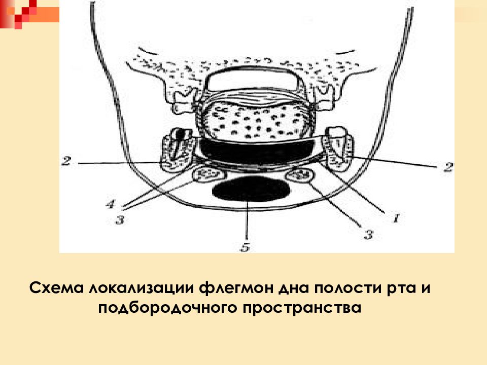 Флегмона дна полости рта презентация