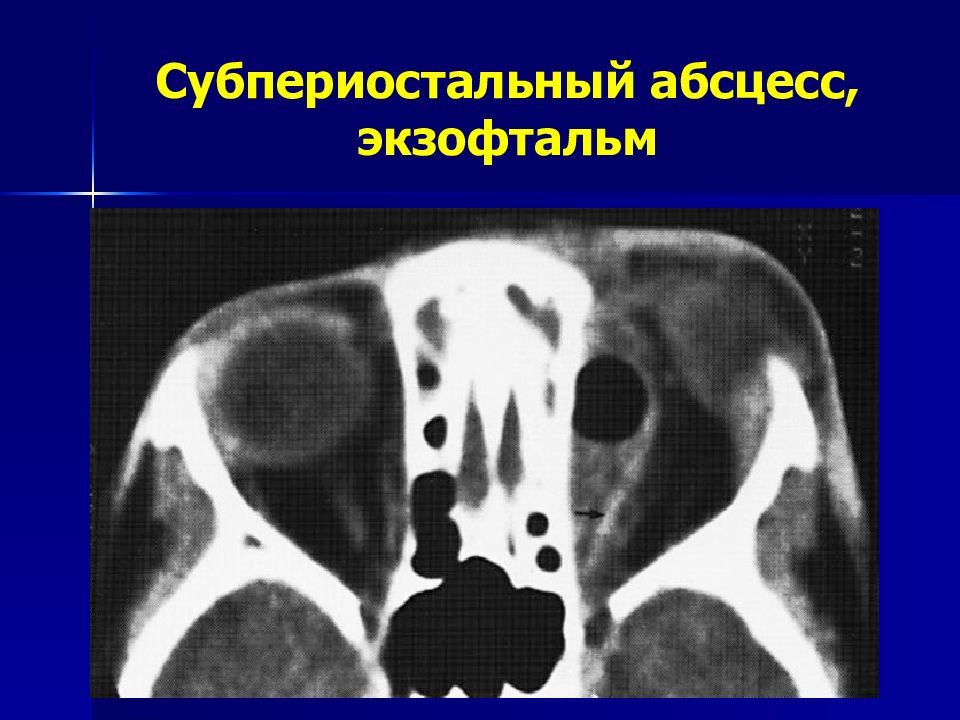 Орбитальные осложнения синуситов презентация