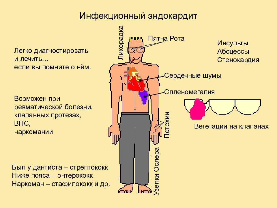 Презентация эндокардиты у детей