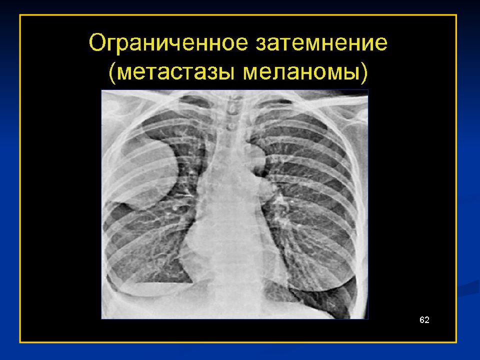 Заболевания органов грудной клетки. Рентгеносемиотика заболеваний органов грудной клетки. Лучевая диагностика дыхательной системы. Ограниченное затемнение легочного. Ограниченное затемнение.