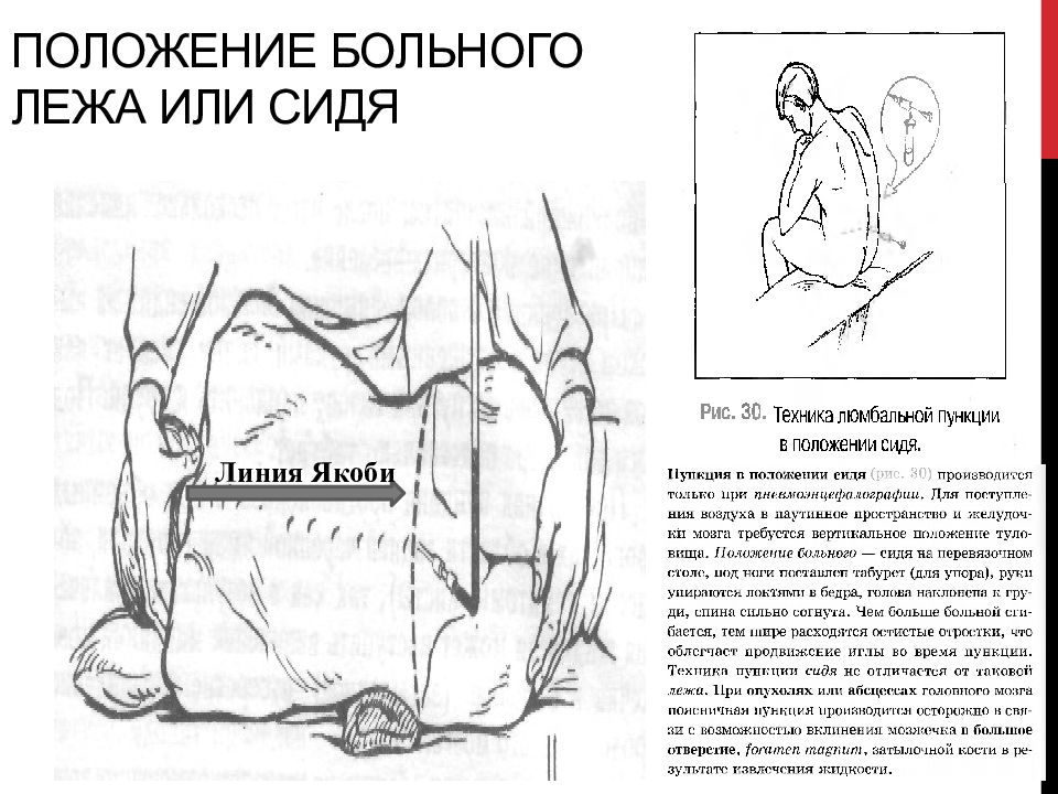 Положение 15. Люмбальная пункция линия Якоби. Линия Якоби при люмбальной пункции. Положение больного при люмбальной пункции. Положение пациента при проведении люмбальной пункции.