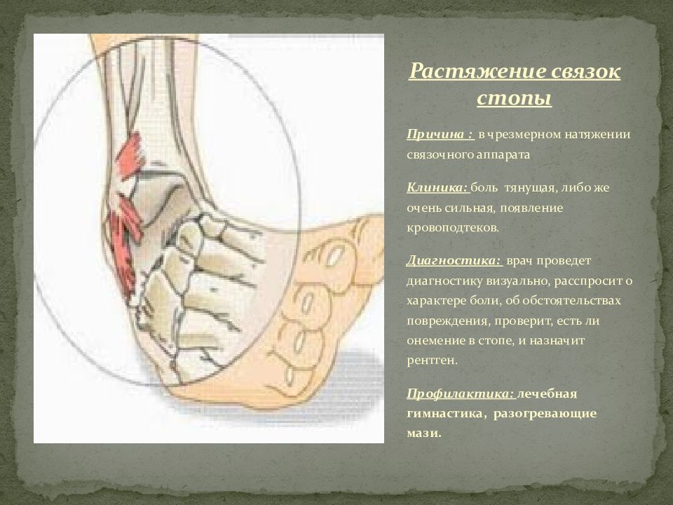 Скажи связку. Растяжение длинной подошвенной связки стопы. Растяжение связочного аппарата. Растяжение латеральной связки стопы. Связочный аппарат стопы разрыв.