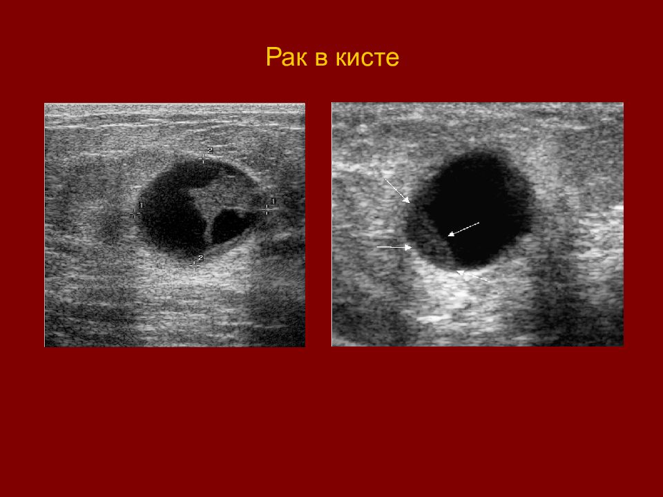 Киста маммография снимки. Цистаденома и киста яичников. Узи картина фибромы мягких тканей. Кистозно расширенный проток молочной железы на узи. Кисты перерождаются в рак.