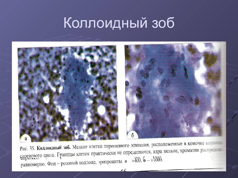 Цитологическая картина коллоидного узла что значит