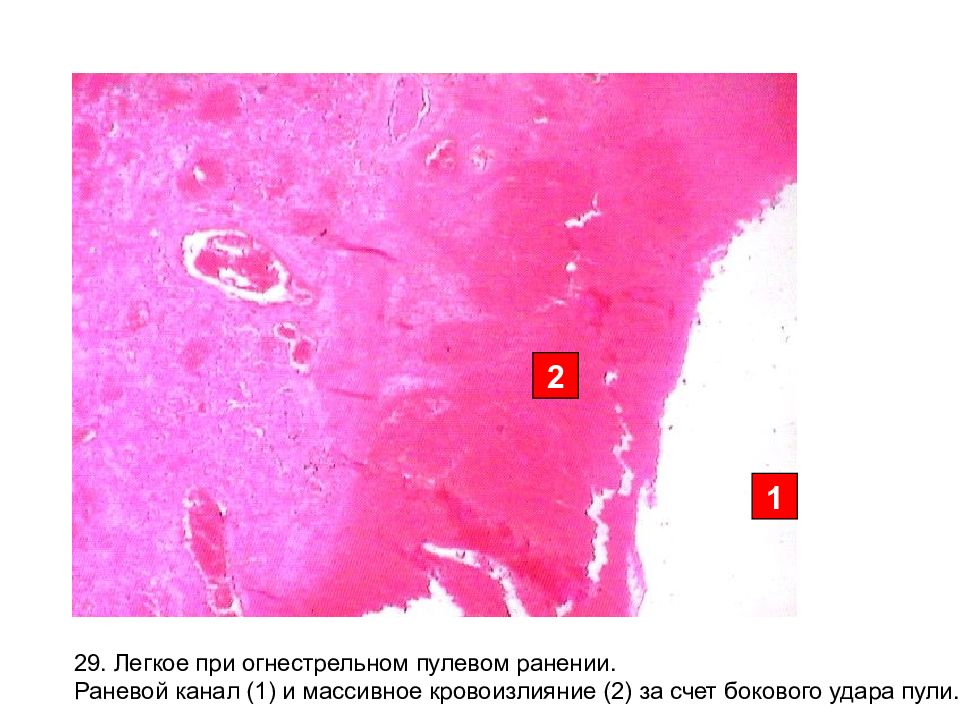 Схема раневого канала