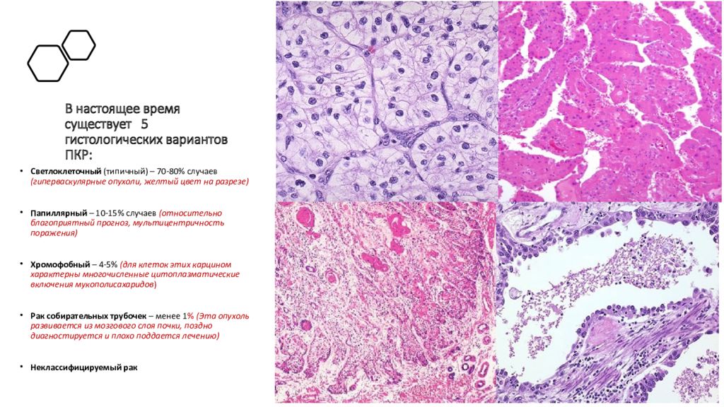 Гистология рака. Папиллярная аденокарцинома почки гистология. Опухоли почки гистология. Гистологическая классификация опухолей мочевого пузыря. Гистологическое строение опухоли.