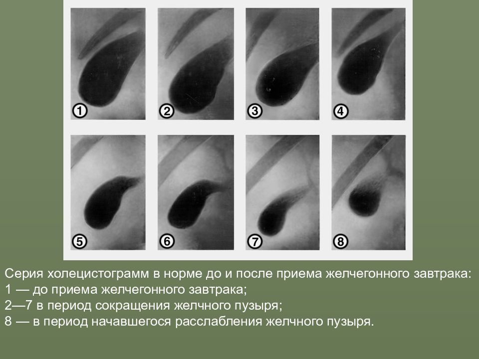 Холецистография направление образец