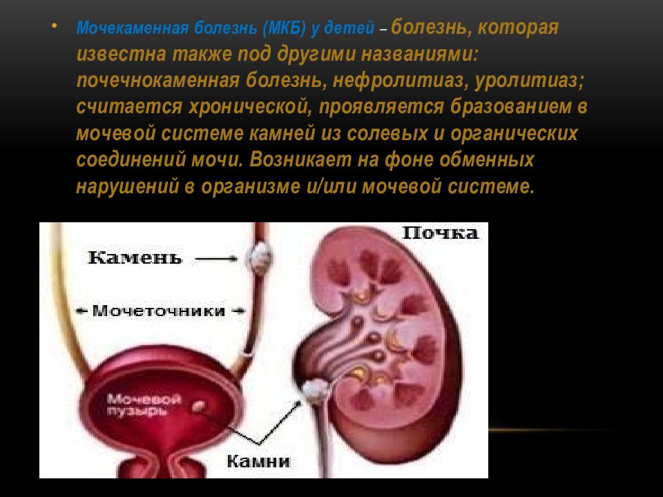 Мочекаменная болезнь у детей презентация