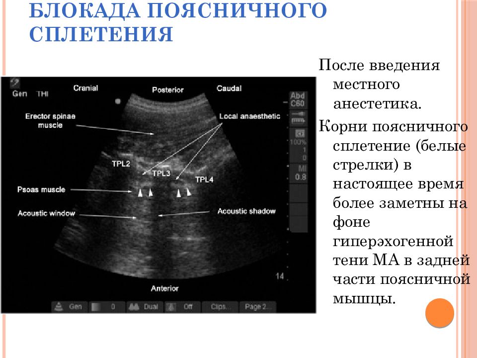 Узи отдела позвоночника. Блокада пояснично крестцового сплетения. Блокада под контролем УЗИ. Блокада поясничного сплетения под контролем УЗИ. Блокада (пояснично-крестцовая зона).