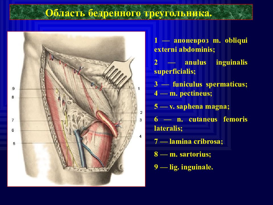 Бедренный треугольник. Поверхностное паховое кольцо anulus inguinalis superficialis. Область бедренного треугольника. Бедренный треугольник топография. Стенки бедренного треугольника.