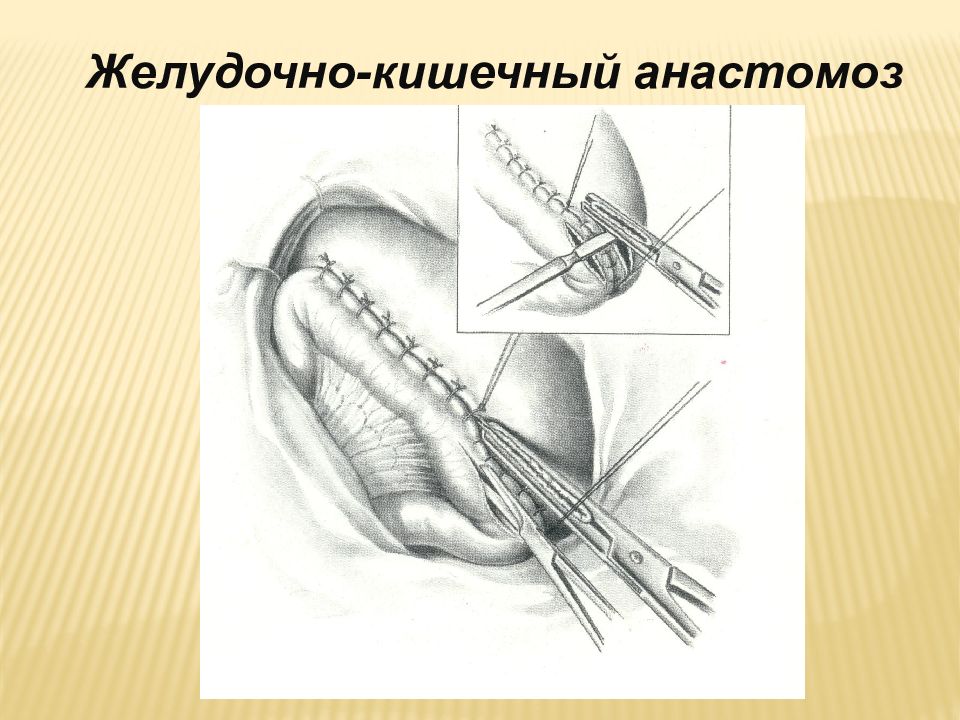 Анастомоз тонкой кишки. Колоректальный анастомоз.