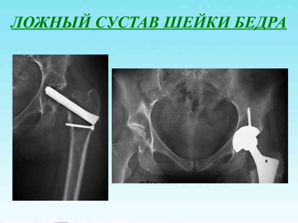 Ложный сустав презентация