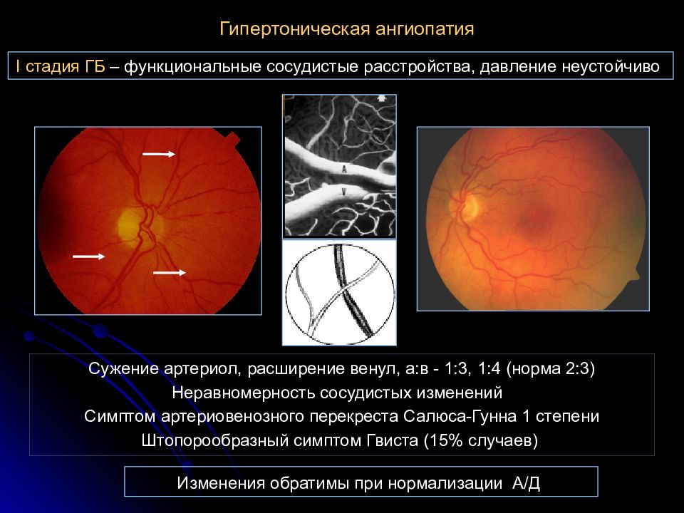 Гипертоническая ангиопатия обоих глаз. Гипертензионная ангиопатия. Гипертоническая ангиопатия и ретинопатия. Гипертоническая ретинопатия 1 стадия. Ангиопатия сетчатки глазное дно.