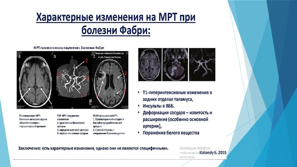 Болезнь фабри презентация