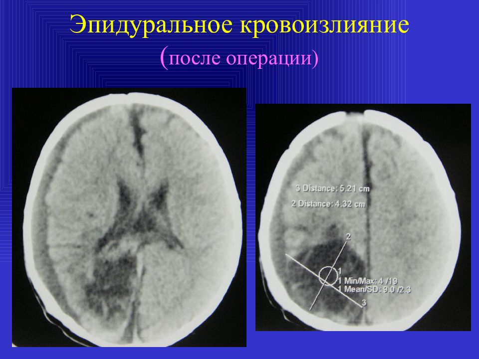 Субдуральное кровоизлияние это. Субдуральная и эпидуральная гематома кт. Эпидуральное кровоизлияние в головной мозг. Внутричерепные кровоизлияния у новорожденных. Эпидуральное кровоизлияние кт.