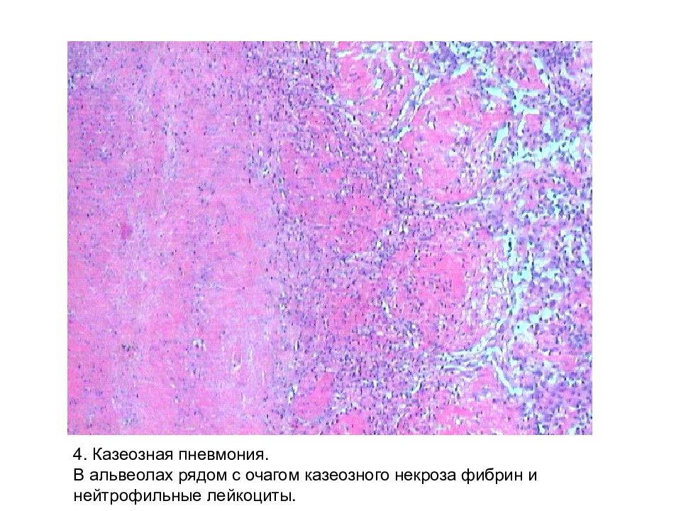 Хроническое венозное полнокровие печени микропрепарат рисунок