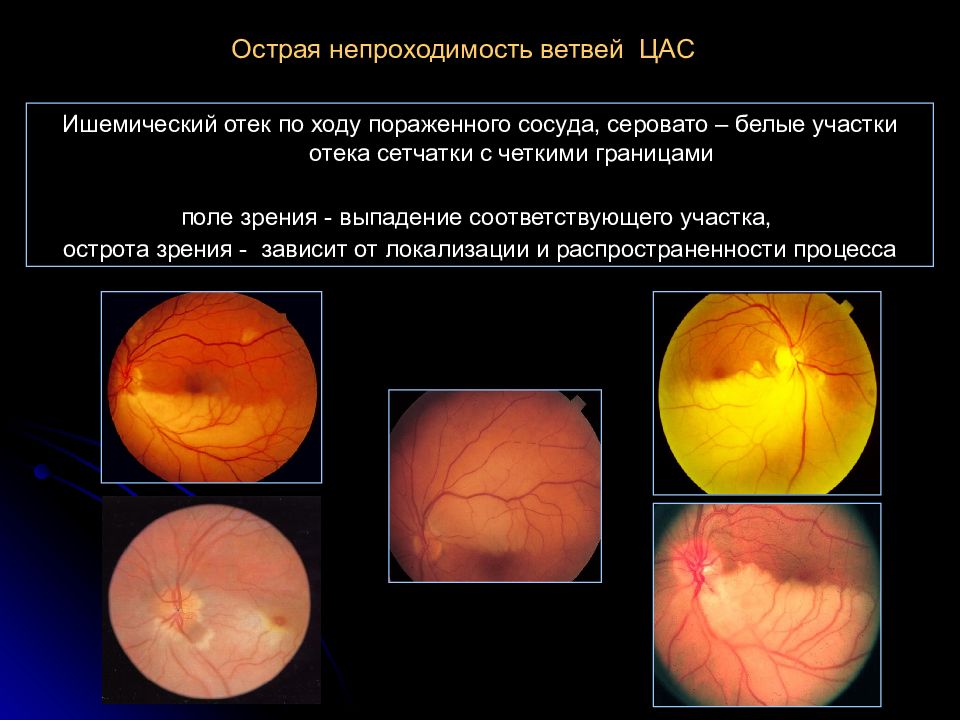 Окклюзия артерии сетчатки. Непроходимость ветвей центральной артерии сетчатки. Острая непроходимость цас. Острая непроходимость центральной артерии сетчатки (цас).. Острая непроходимость ветви центральной артерии сетчатки.