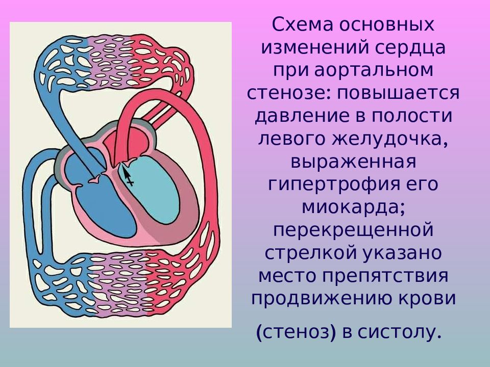 Сердечные изменения. Изменение сердца при аортальном стенозе. Изменение гемодинамики при аортальном стенозе. Схема сердца при пороках. Сердце при аортальном стенозе.