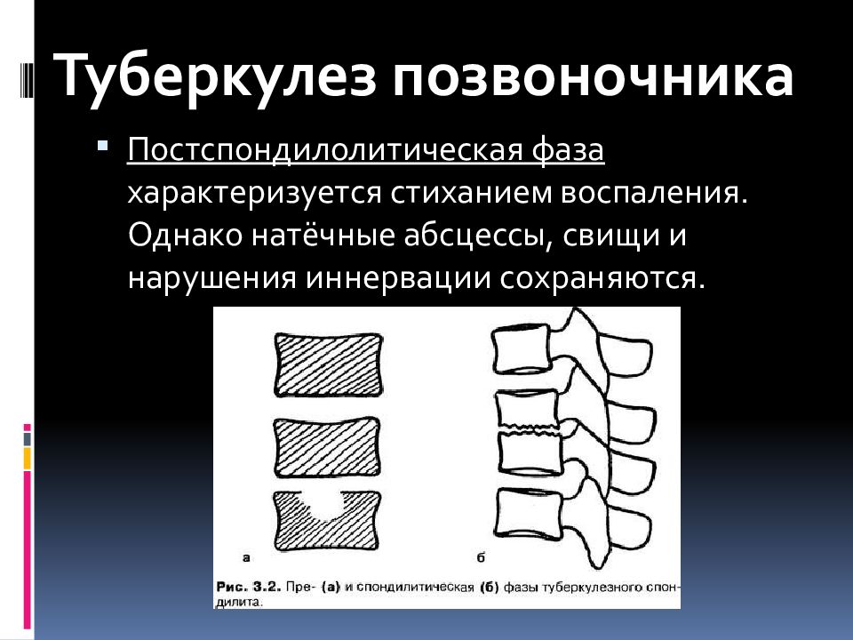 Туберкулез позвоночника презентация