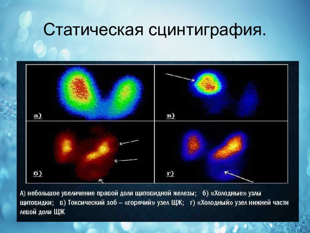 Сцинтиграфия желез. Сцинтиграфия щитовидной железы узлы. Холодный узел щитовидной железы сцинтиграфия. Горячий узел в щитовидной железе сцинтиграфия. Сцинтиграфия щитовидной железы горячие и холодные узлы.