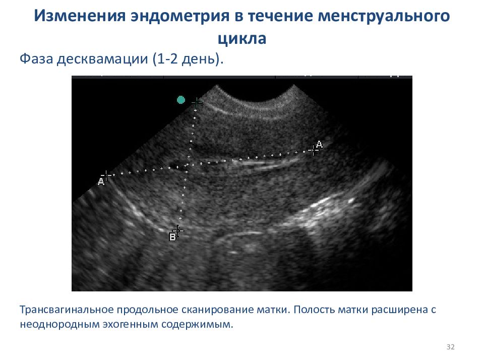 Перед месячными какая эндометрия должна быть. Десквамация эндометрия УЗИ. УЗИ 2 фазы менструационного цикла. Фаза десквамации эндометрия на УЗИ. Эндометрия матки 2мм.