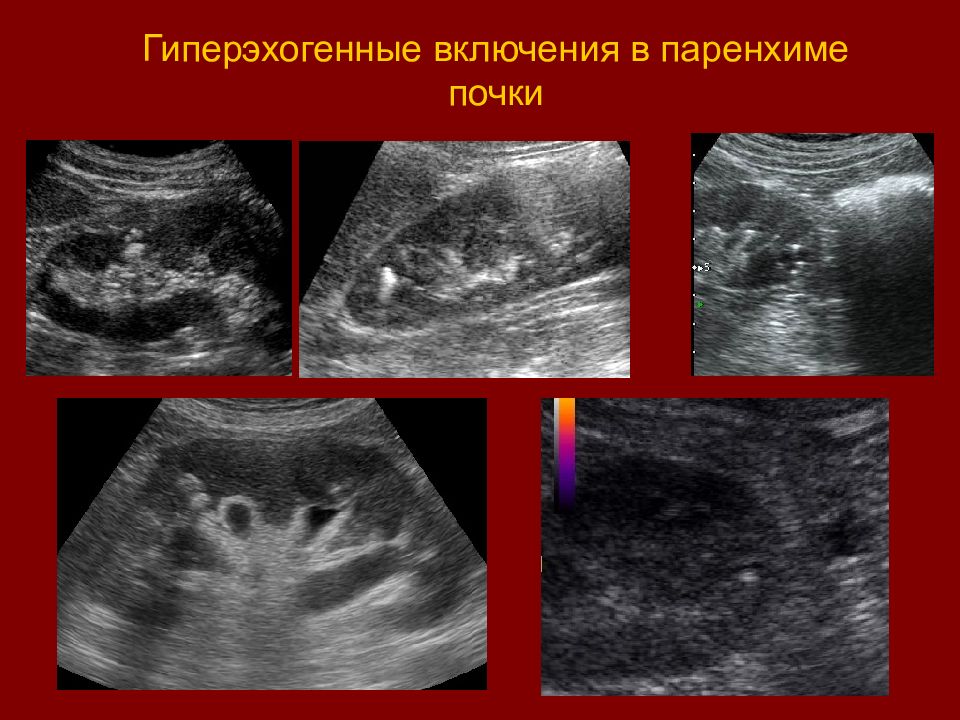 Синус гиперэхогенный. Гиперэхогенный УЗИ почки. Гиперэхогенные пирамидки в почках на УЗИ. Гиперэхогенные включения ЧЛС почек УЗИ. Гиперэхогенные включения в паренхиме почек на УЗИ.