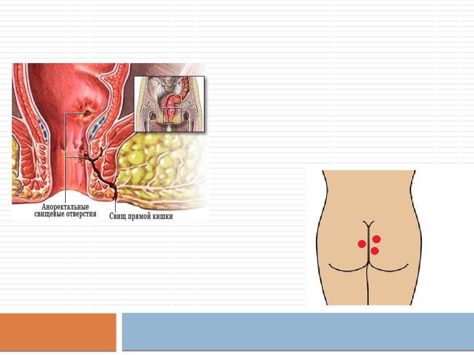 Парапроктит и свищи прямой кишки презентация