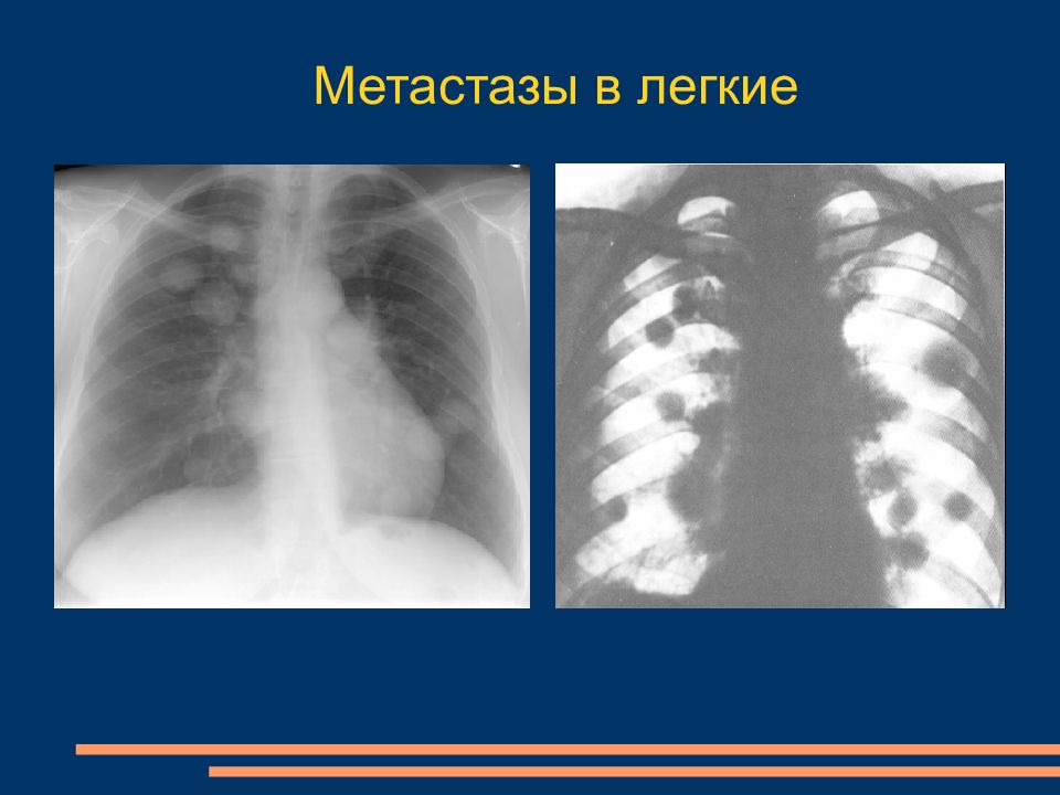 Метастазы что это. Метастазы в легкие на рентгенограмме. Гематогенные метастазы в легких рентген. Метастазы в легкие рентген.