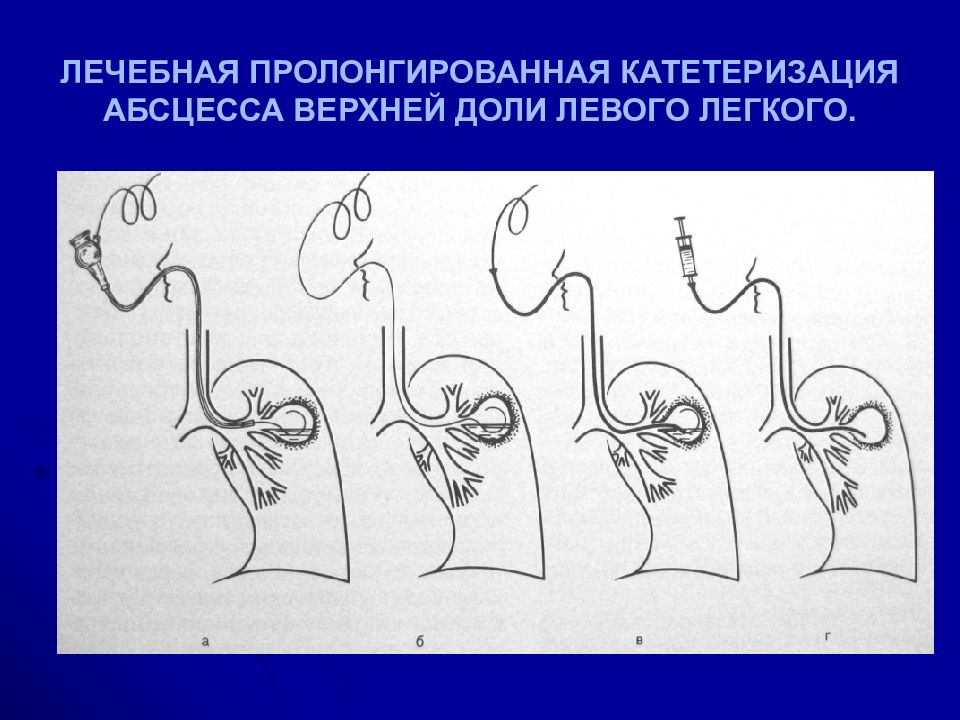 Острая гнойная деструктивная пневмония у детей презентация