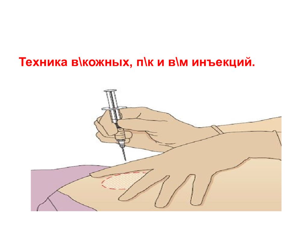 В м инъекция. Техника в/м инъекции. Техника п/к инъекции.