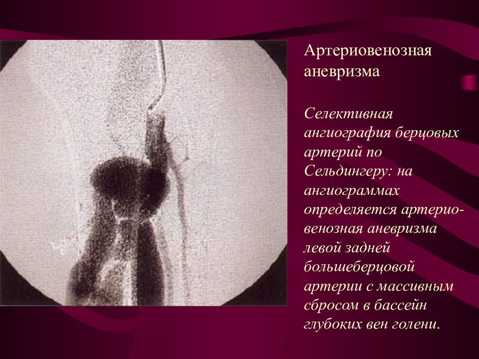 пункция артерии по сельдингеру. селективная ангиография по сельдингеру. артериография по сельдингеру. ангиография по сельдингеру. ангиография по сельдингеру.