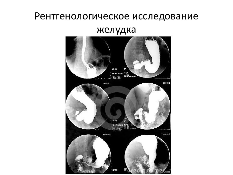 Диагностическое значение визуальной эндоскопической картины при заболеваниях желудка и кишечника