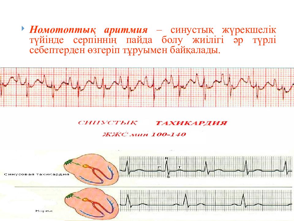 Аритмии презентация факультетская терапия