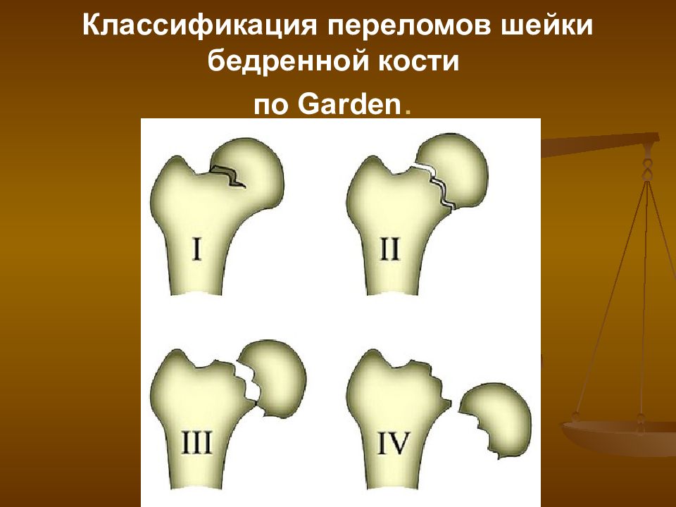 Шейка кости. Классификация вертельных переломов бедра. Классификация переломов шейки бедренной кости по Garden. Чрезвертельный перелом шейки бедра классификация. Гарден классификация переломов шейки бедра.