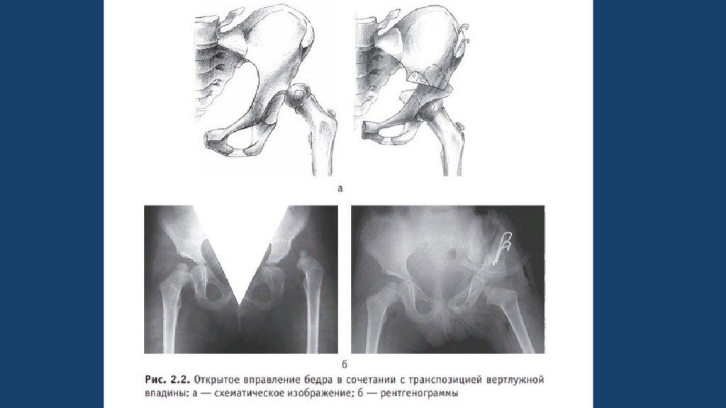 Врожденные вывихи бедра презентация
