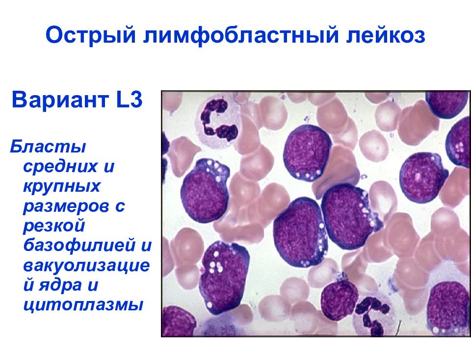 Острый лимфолейкоз презентация