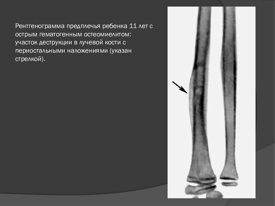 Диафиз костей предплечья. Остеомиелит предплечья рентген. Остеомиелит периостальная реакция. Периостальные реакции при остеомиелите.